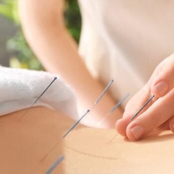 Acupuncture A Acupuncture